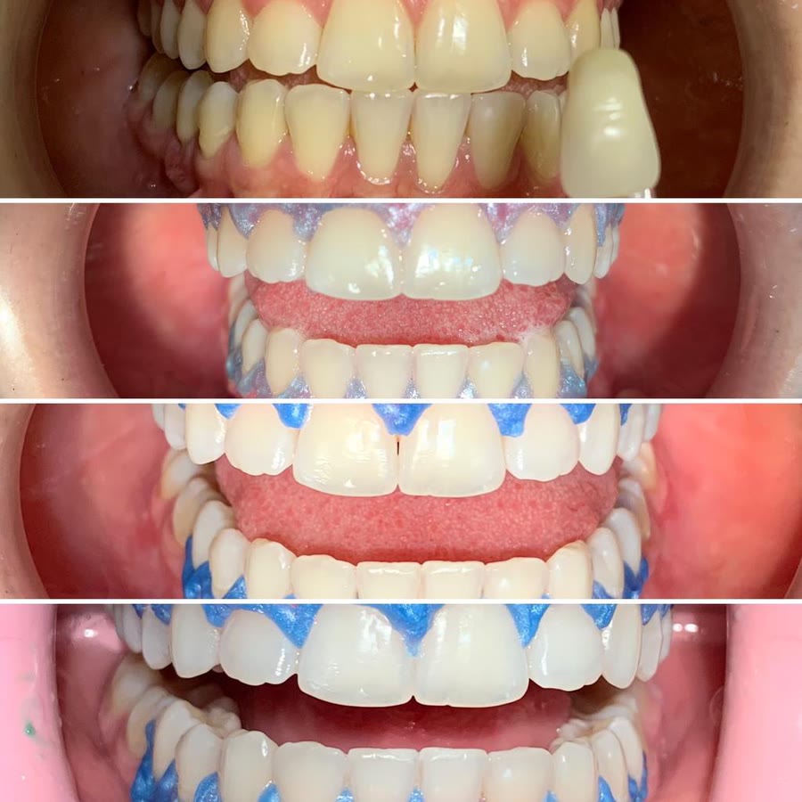 Quatro fotos do clareamento dental: os dentes ficando mais claros a cada sessão, com a escala de cor na primeira foto