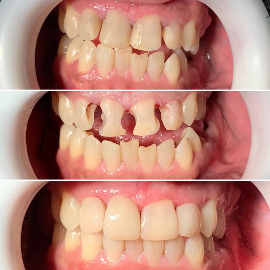 Três fotos dos dentes da frente: antes, desgastados e separados; durante, preparados; depois, refeitos e alinhados
