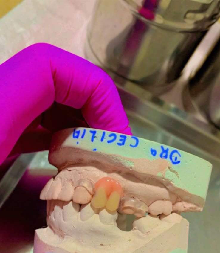 Prótese parcial flexível com dois dentes, encaixada num modelo de gesso, sem grampo de metal
