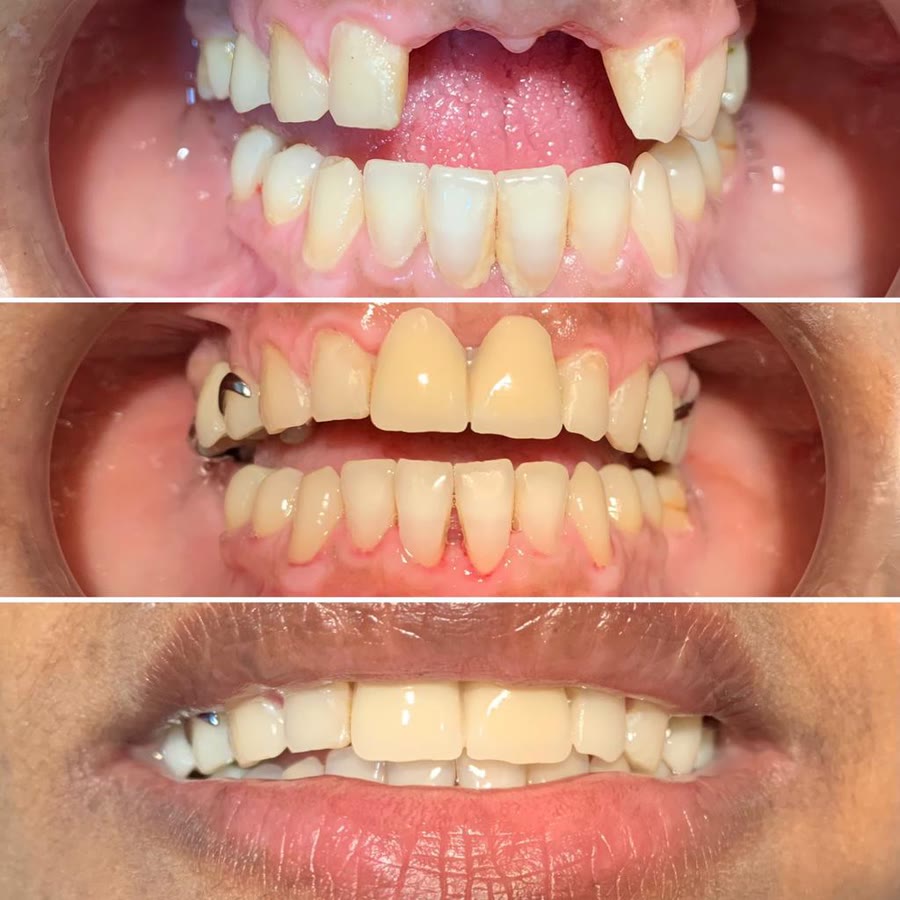 Três fotos: antes, sem os dentes da frente; com a prótese parcial colocada; e o sorriso final com os lábios
