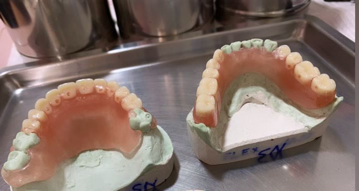 Par de próteses flexíveis, superior e inferior, sobre os modelos de gesso numa bandeja de inox